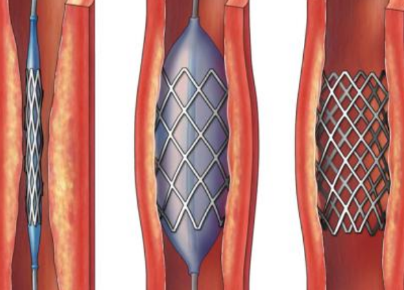 好消息！700元冠脈支架來了帶量采購結(jié)果在甘肅省正式落地執(zhí)行